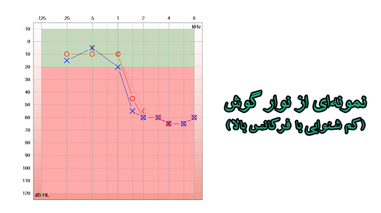 audiogram-example نمونه نوارگوش با کم شنوایی