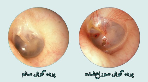 perforated eardrum عکس پارگی پرده گوش