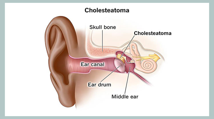 cholesteatoma تصویر بیماری Cholesteatoma
