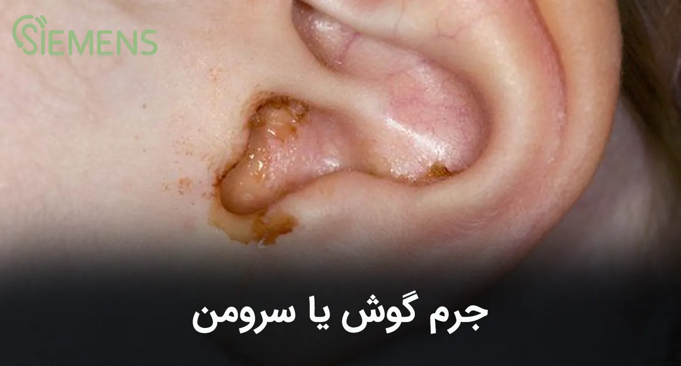 جرم گوش
