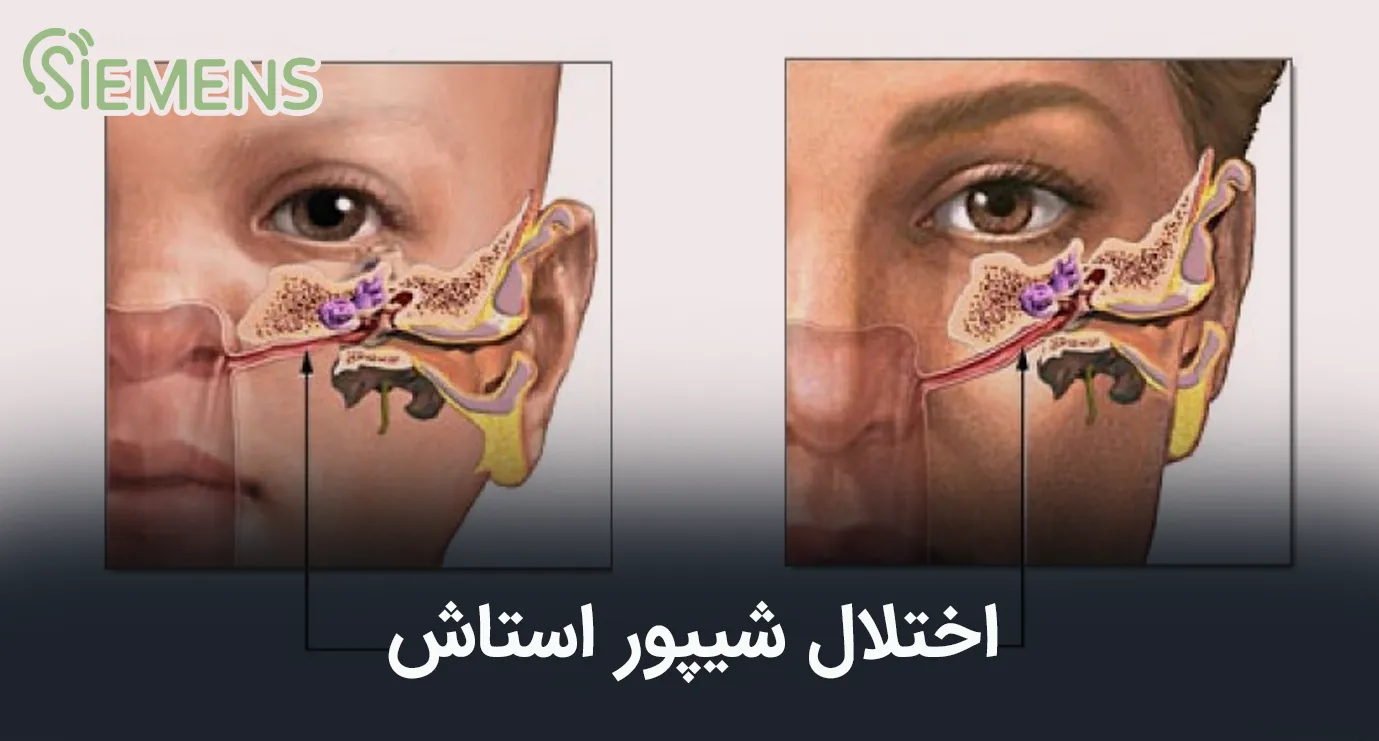 اختلال شیپور استاش