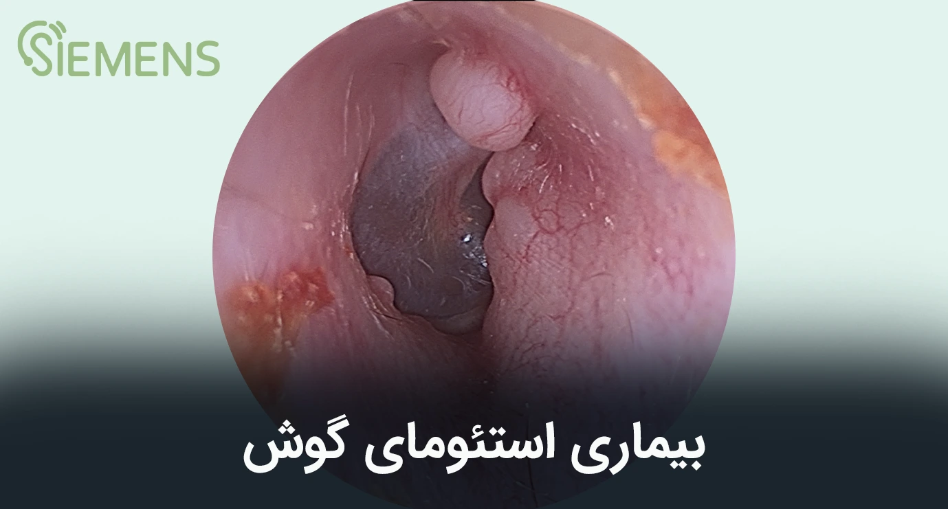 بیماری استئومای گوش