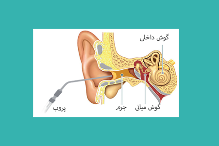 microsuction-method نحوه انجام ساکشن گوش
