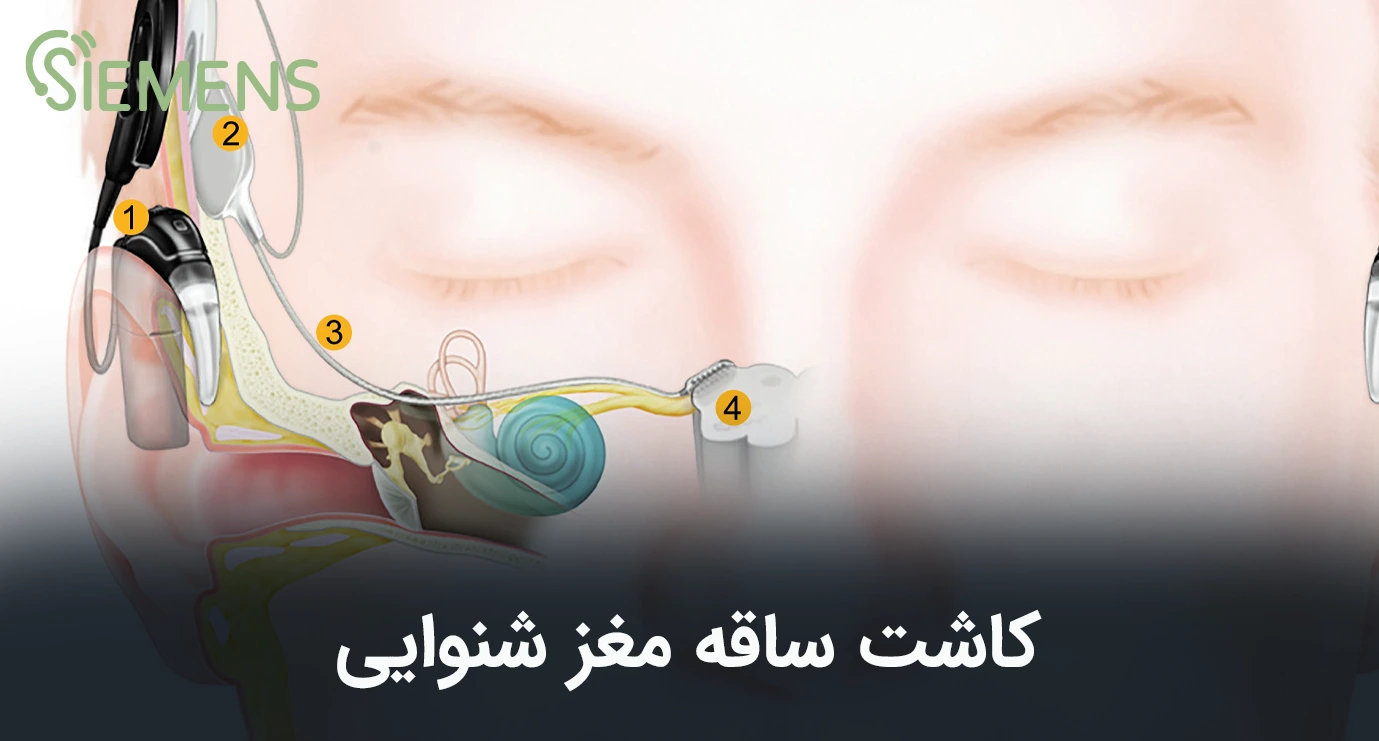 کاشت ساقه مغز شنوایی