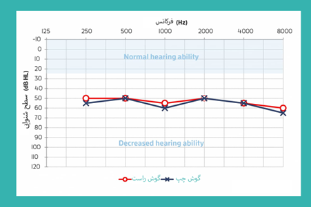 speech audiogram نماد روی ادیوگرام