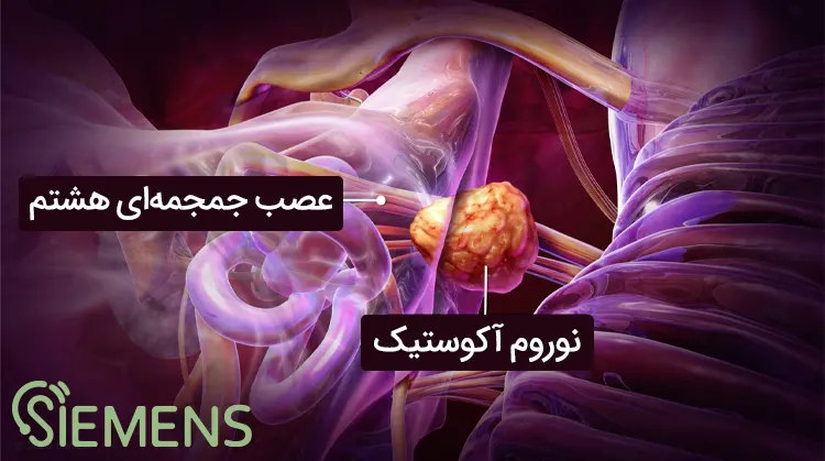 acoustic neuroma-cover نوروم آکوستیک