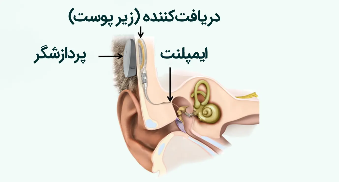 middle-ear-implant-annotated کاشت سمعک
