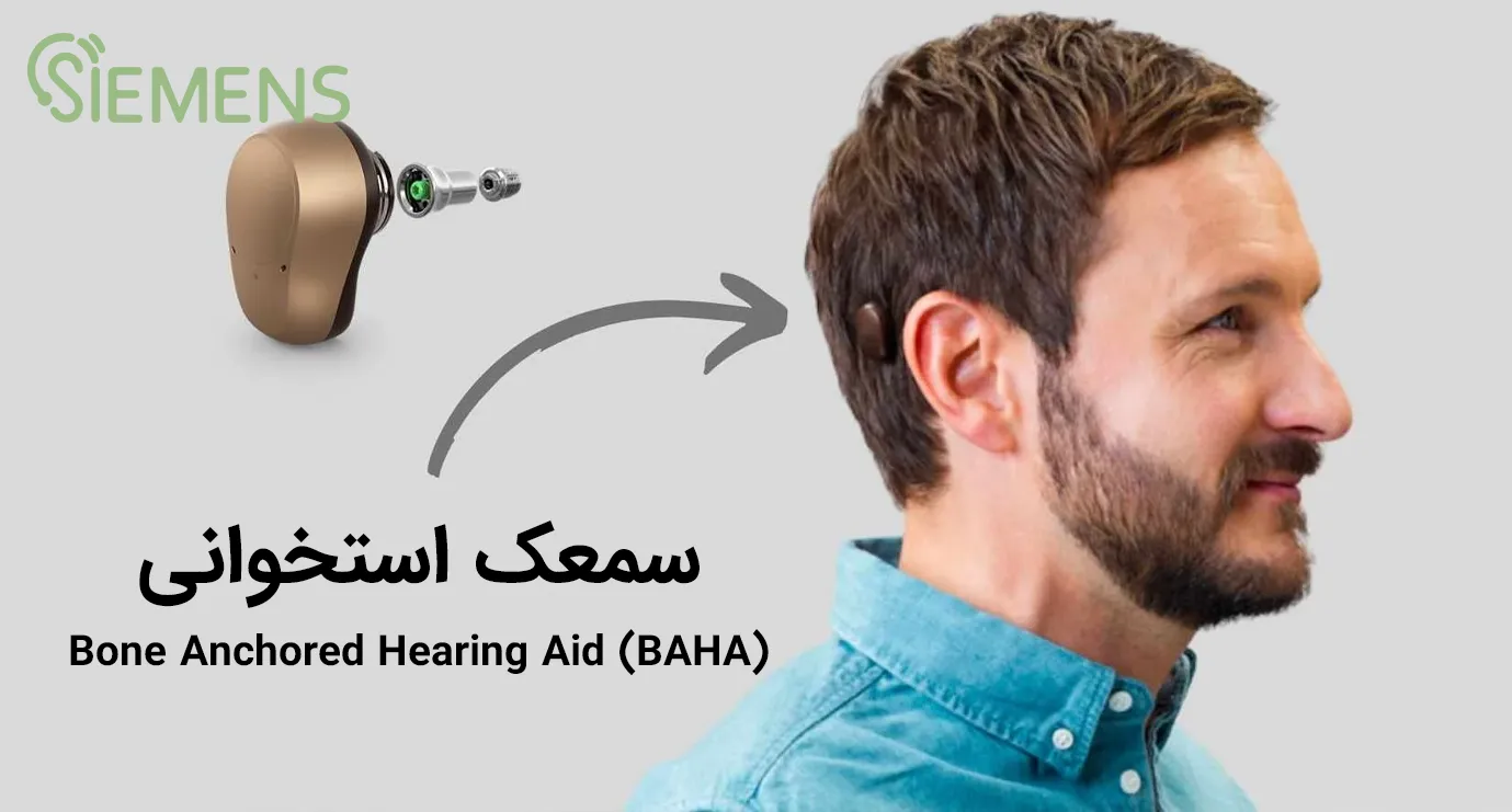 Bone Anchored Hearing Aid (BAHA) معرفی انواع سمعک استخوانی