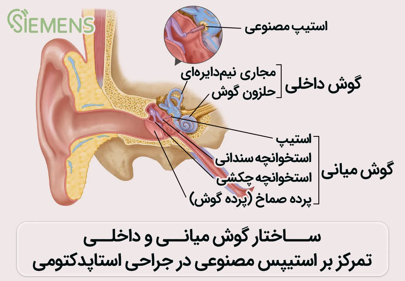 stapedotomy-surgery-two ساختار گوش میانی و داخلی در عمل استاپدکتومی
