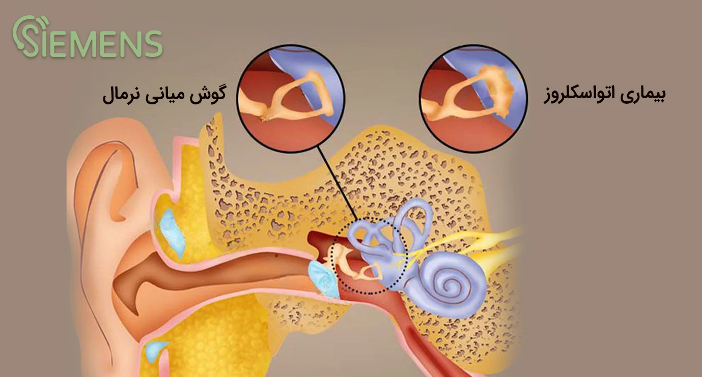 otosclerosis-graph تصویر بیماری اتواسکلروز در مقابل گوش سالم