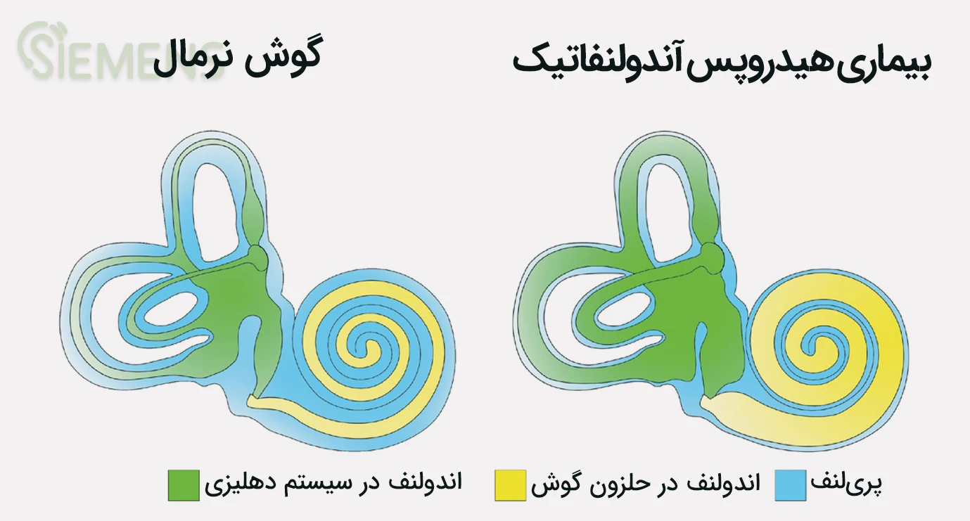 endolymphatic hydrops disease info
