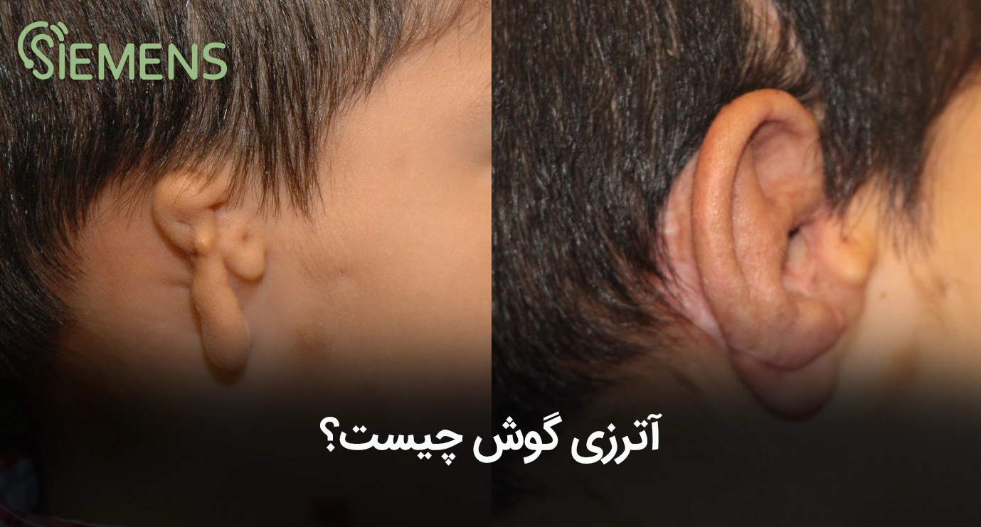 تصویر آترزی گوش