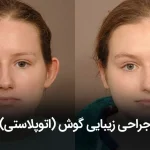 جراحی زیبایی گوش(اتوپلاستی)
