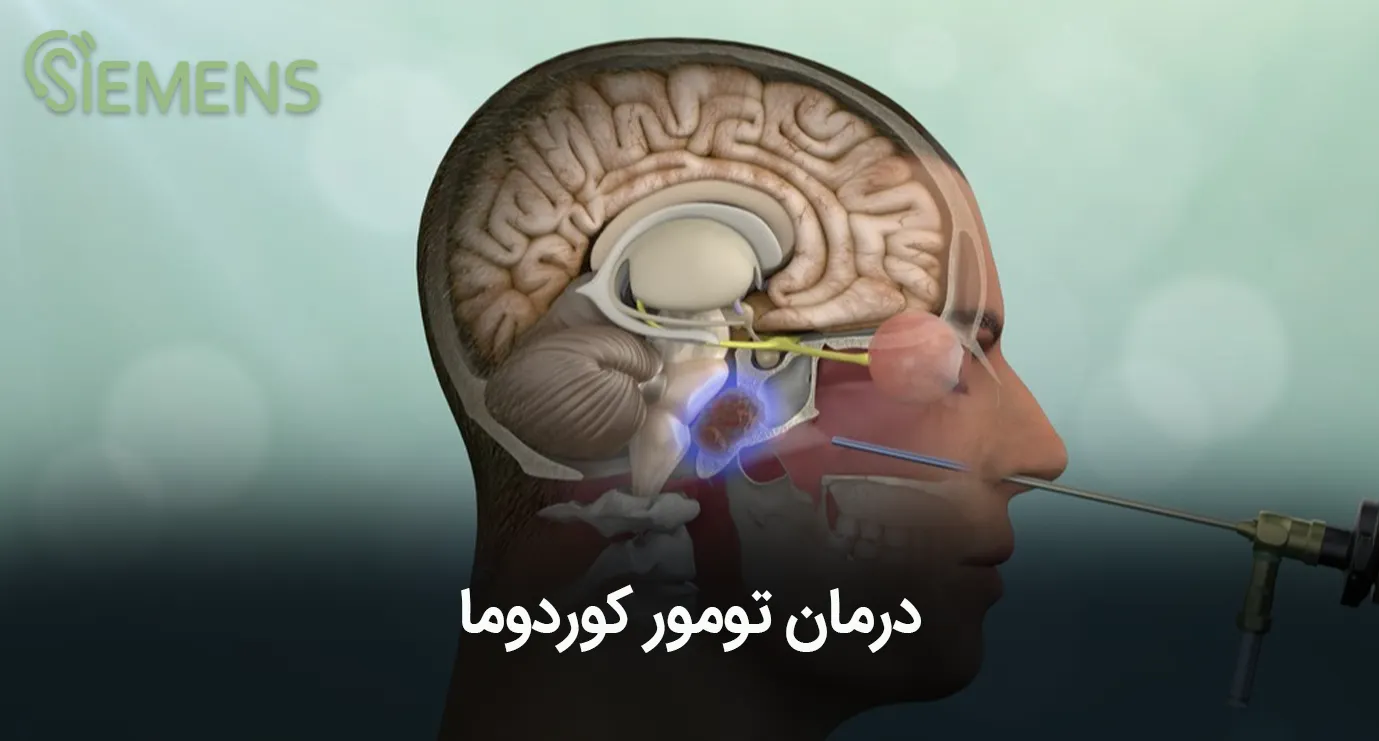 تومور کوردوما