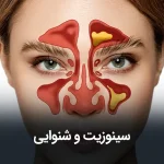 گرفتگی گوش ناشی از سینوزیت