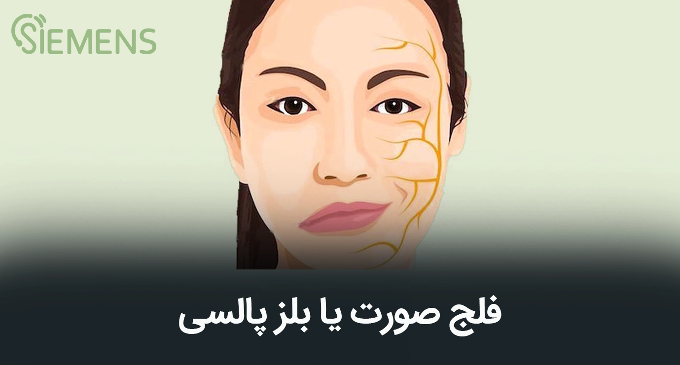 فلج بل پالسی یا فلج عصب هفت چیست