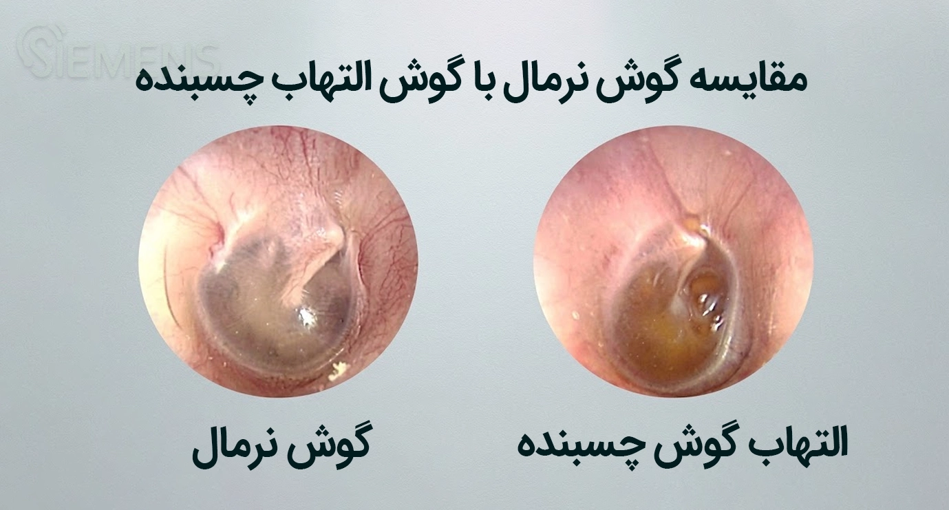 normal-vs-glue ear مقایسه گوش نرمال با گوش التهاب گوش چسبنده